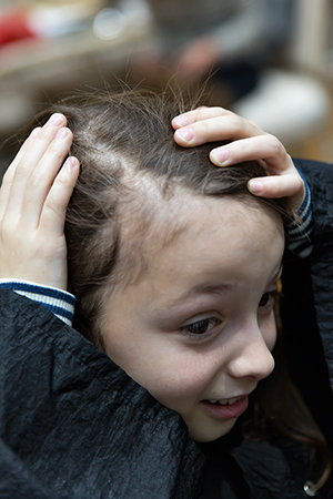 Tinea Capitis and Hair Loss in Children