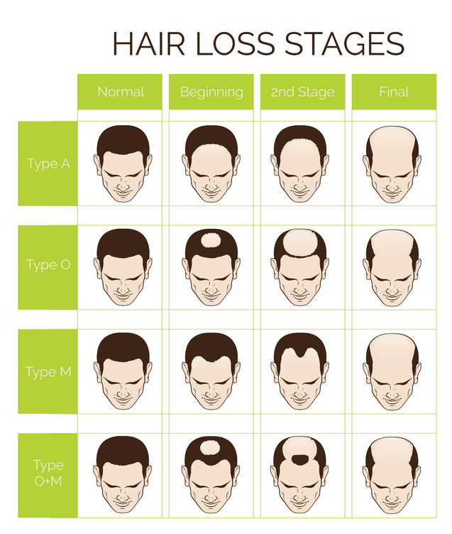 Hair Loss Diagram Bournemouth clinic