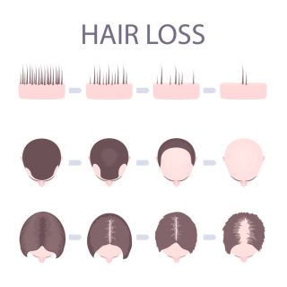 Types Of Hair Loss