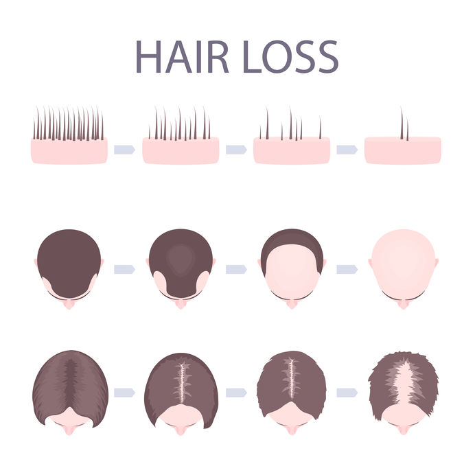 Female Pattern Baldness Template Hair Loss Clinic Dorset