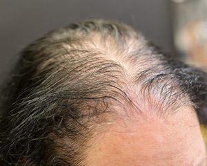 Hair Loss Diagnosis and treatment Dorset