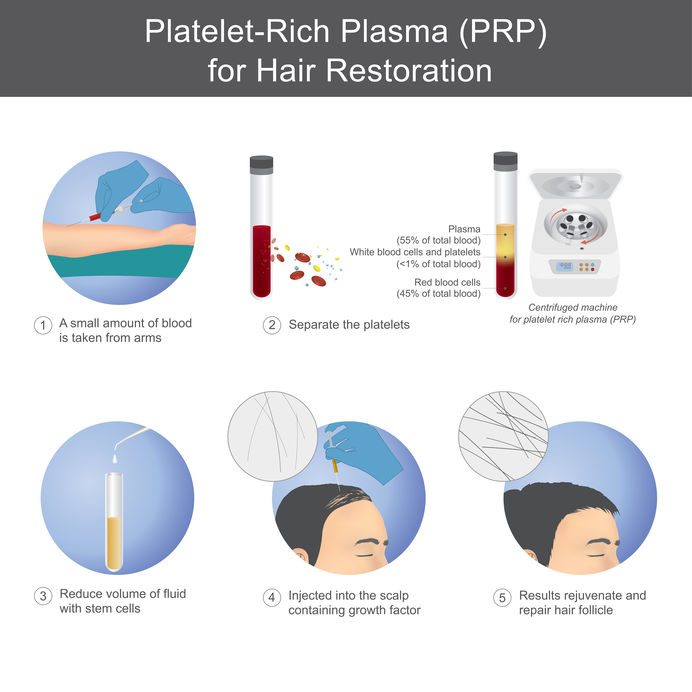 PRP hair loss treatments Bournemouth Trichology Clinic