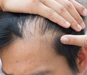 Expert advice on hair loss conditions from Simone Thomas Trichology Clinics in Dorset